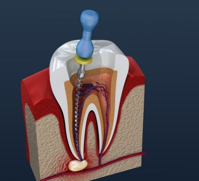 imagen de tratamiento de endodoncia en bermeo