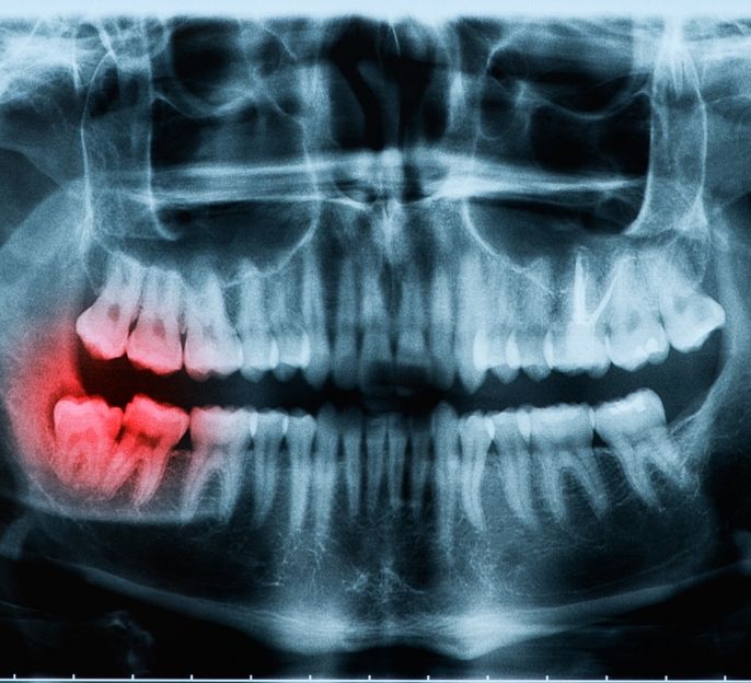 imagen de cirugia oral en bermeo clinica dental extraccion muelas del juicio