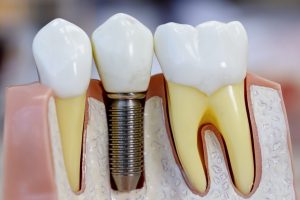 Ventajas de la colocación de implantes dentales en Madrid
