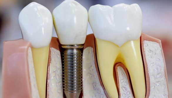 Ventajas de la colocación de implantes dentales en Madrid