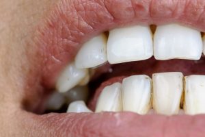 5 motivos que pueden provocar manchas dentales