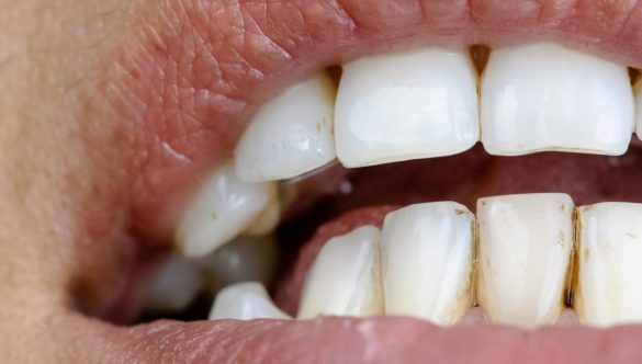 5 motivos que pueden provocar manchas dentales