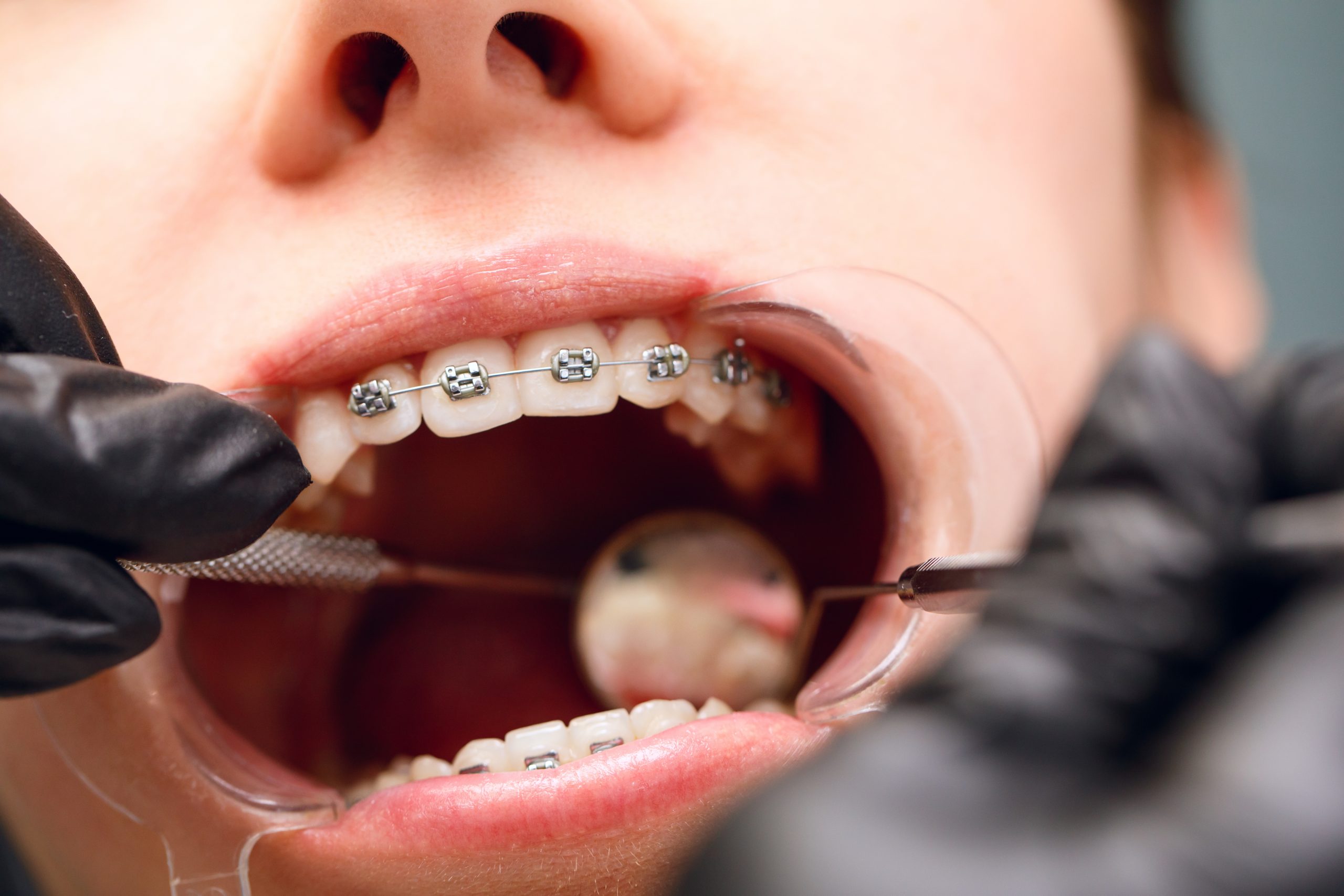 ¿Cuáles son las fases claves de un tratamiento de ortodoncia? 